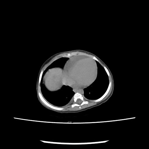 Caroli disease with autosomal recessive polycystic kidney disease (ARPKD) (Radiopaedia 89651-106703 E 9).jpg