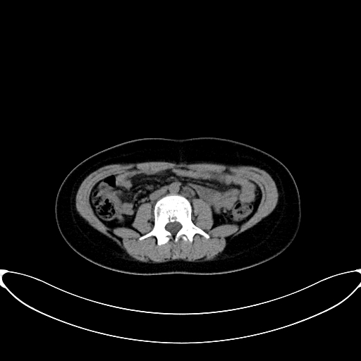 Caroli disease with medullary sponge kidney (Radiopaedia 82622-96804 Axial non-contrast 39).jpg