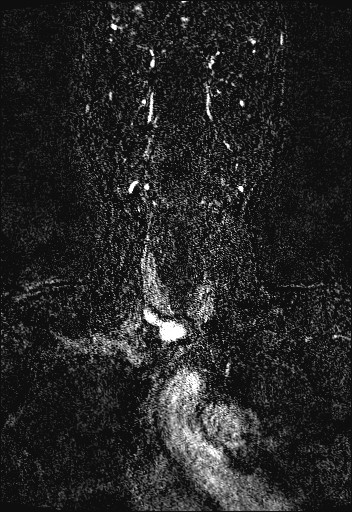Carotid artery dissection (Radiopaedia 28441-28689 Coronal MRA 15).jpg