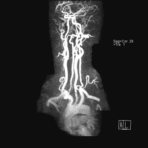 File:Carotid artery dissection (Radiopaedia 28441-28689 MIP Carotids MRA 4).jpg
