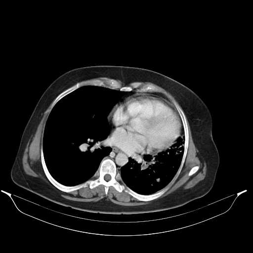 File:Carotid body tumor (Radiopaedia 21021-20948 A 41).jpg