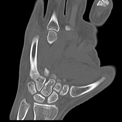 File:Carpo-metacarpal fracture-dislocations with hamatum split fracture (Radiopaedia 18482-18343 Coronal bone window 12).jpg