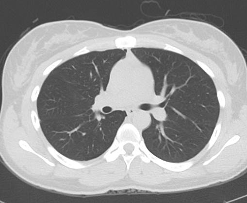 File:Catamenial pneumothorax (Radiopaedia 54382-60600 Axial 3).png