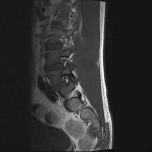 File:Cauda equina syndrome (Radiopaedia 53615-59672 Axial T1 4).png