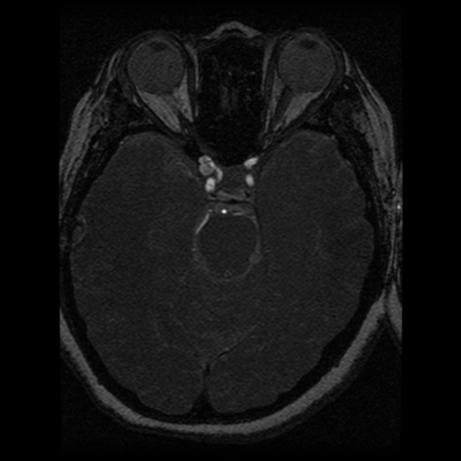 Cavernoma, DVA and right ICA aneurysm (Radiopaedia 33890-35072 E 55).png