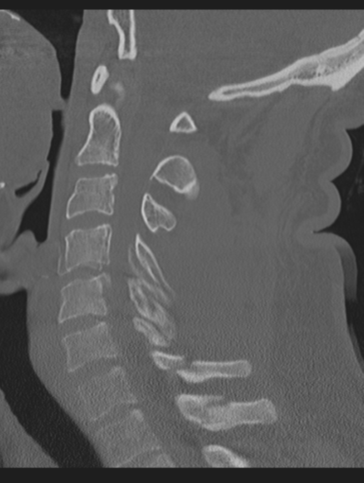 Cavernoma of cervical cord (Radiopaedia 50838-56346 Sagittal bone window 43).png
