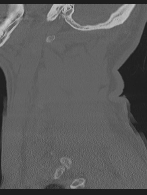 Cavernoma of cervical cord (Radiopaedia 50838-56346 Sagittal bone window 67).png