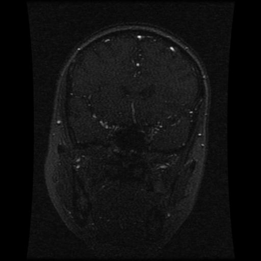 Cavernoma with developmental venous anomaly (Radiopaedia 22470-22507 MRV 88).jpg