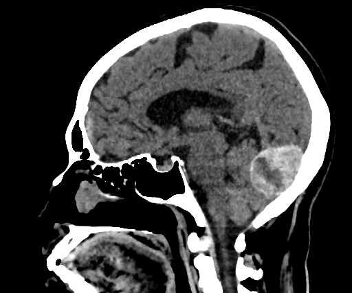 Cavernous hemangioma of the cerebellar falx (Radiopaedia 73025-83723 B 174).jpg
