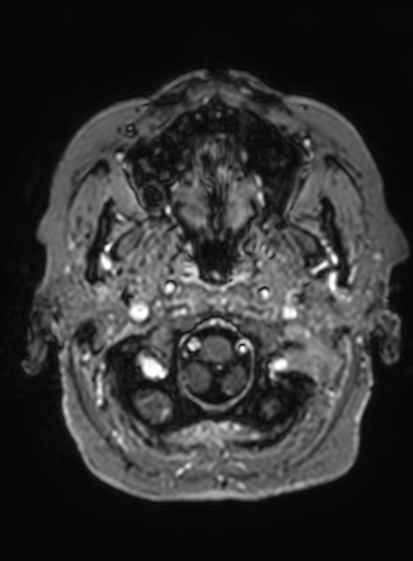 Cavernous hemangioma of the cerebellar falx (Radiopaedia 73025-83724 Axial T1 C+ 316).jpg