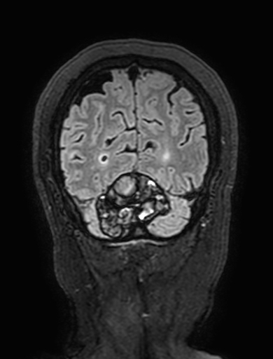 Cavernous hemangioma of the cerebellar falx (Radiopaedia 73025-83724 Coronal FLAIR 306).jpg