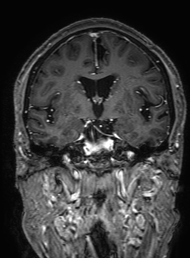 Cavernous hemangioma of the cerebellar falx (Radiopaedia 73025-83724 Coronal T1 C+ 177).jpg