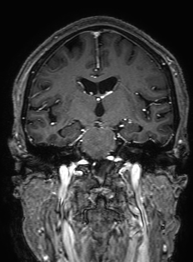 Cavernous hemangioma of the cerebellar falx (Radiopaedia 73025-83724 Coronal T1 C+ 195).jpg