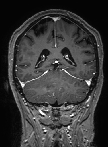Cavernous hemangioma of the cerebellar falx (Radiopaedia 73025-83724 Coronal T1 C+ 261).jpg