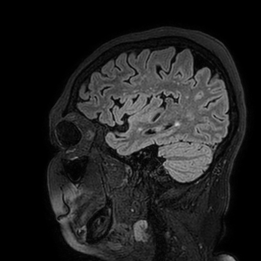 Cavernous hemangioma of the cerebellar falx (Radiopaedia 73025-83724 Sagittal FLAIR 169).jpg