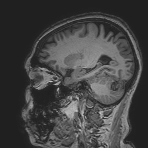 File:Cavernous hemangioma of the cerebellar falx (Radiopaedia 73025-83724 Sagittal T1 72).jpg