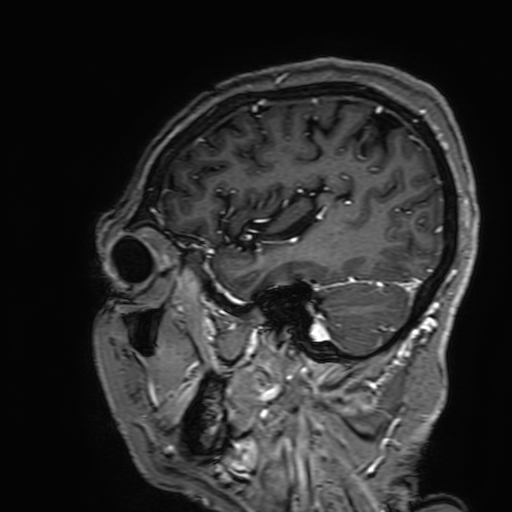 File:Cavernous hemangioma of the cerebellar falx (Radiopaedia 73025-83724 Sagittal T1 C+ 165).jpg