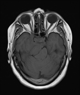 File:Cavernous sinus meningioma (Radiopaedia 63682-72367 Axial T1 8).jpg