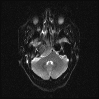 Cavernous sinus meningioma (Radiopaedia 63682-72367 DWI 6).jpg