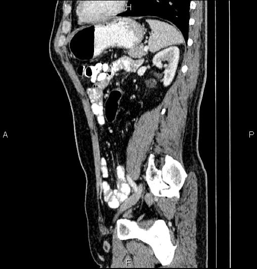 Cecal adenocarcinoma (Radiopaedia 85324-100916 E 63).jpg