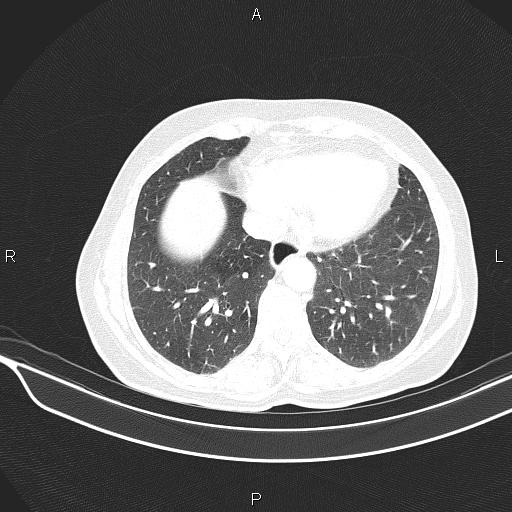Cecal cancer (Radiopaedia 85610-101358 Axial lung window 48).jpg