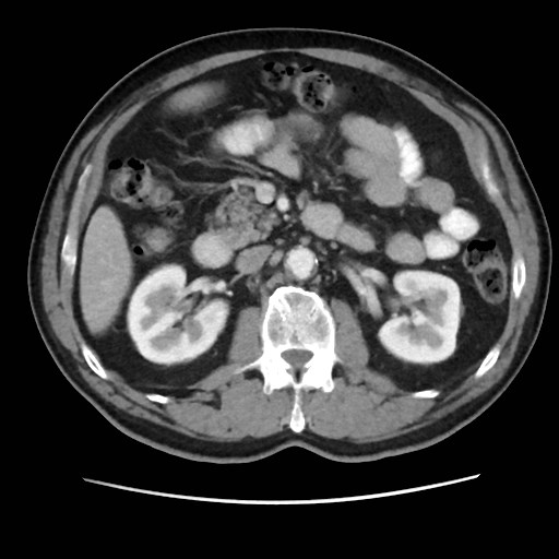Cecal mass causing appendicitis (Radiopaedia 59207-66531 A 35).jpg