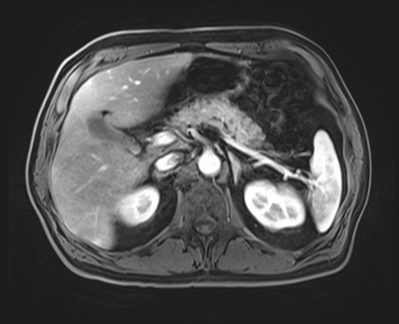 File:Cecal mass causing appendicitis (Radiopaedia 59207-66532 H 46).jpg