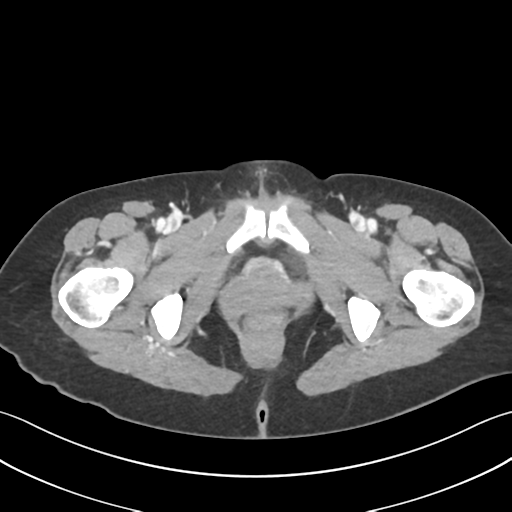 Cecum hernia through the foramen of Winslow (Radiopaedia 46634-51112 A 76).png