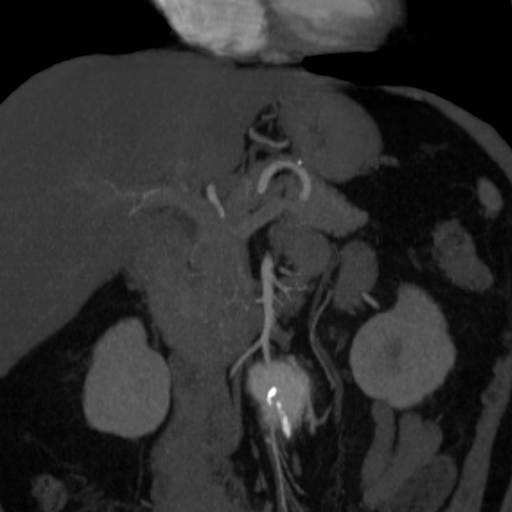 File:Celiac artery compression by the diaphragmatic crurae (Radiopaedia 31739-32666 B 2).jpg