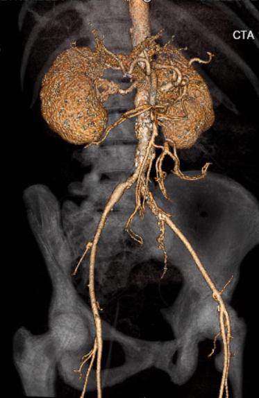 File:Celiac artery severe stenosis and dissection (Radiopaedia 44128-47842 C+ arterial phase 3).jpg