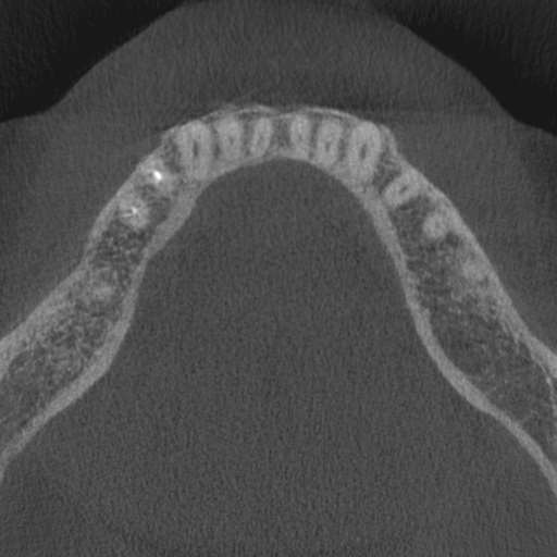 File:Cemento-osseous dysplasia (Radiopaedia 48251-53126 Axial non-contrast 34).jpg