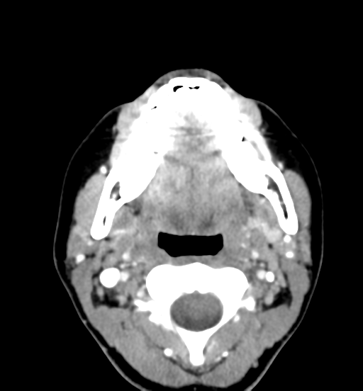 File:Cemento-ossifying fibroma (Radiopaedia 46243-50643 Axial C+ delayed 38).png