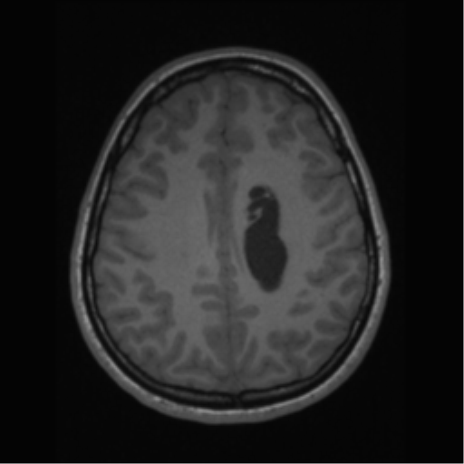 File:Central neurocytoma (Radiopaedia 37664-39557 Axial T1 53).png