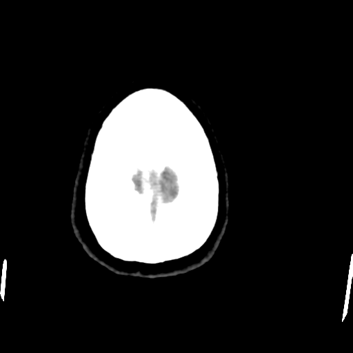 Central neurocytoma (Radiopaedia 65317-74346 Axial non-contrast 47).png
