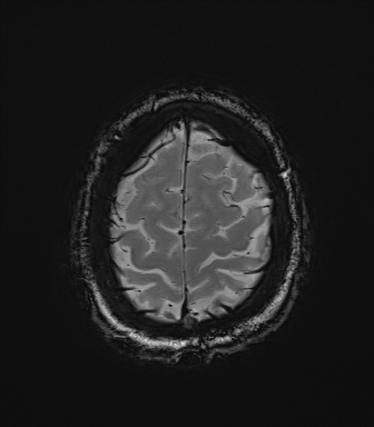 File:Central neurocytoma (Radiopaedia 71068-81303 Axial SWI 59).jpg