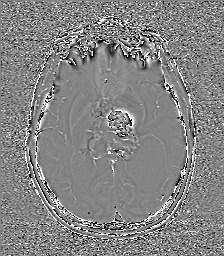 Central neurocytoma (Radiopaedia 84497-99872 Axial 36).jpg
