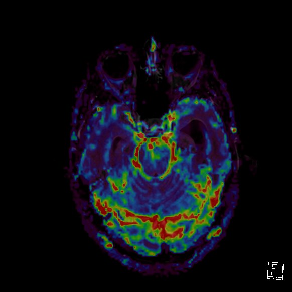 Central neurocytoma (Radiopaedia 84497-99872 Axial Perfusion 220).jpg