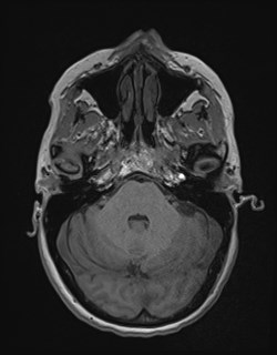 Central neurocytoma (Radiopaedia 84497-99872 Axial T1 55).jpg