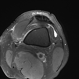 File:Central osteophyte (Radiopaedia 72592-83151 Axial PD fat sat 1).jpg
