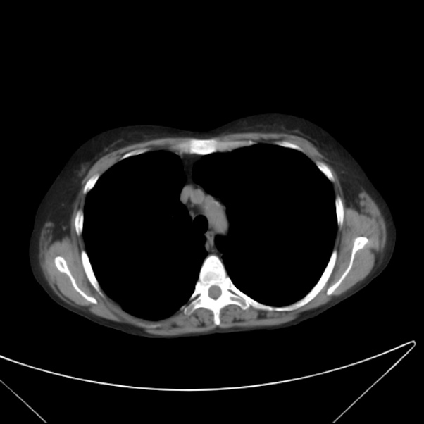 Centrilobular pulmonary emphysema (Radiopaedia 24495-24789 Axial non-contrast 15).jpg