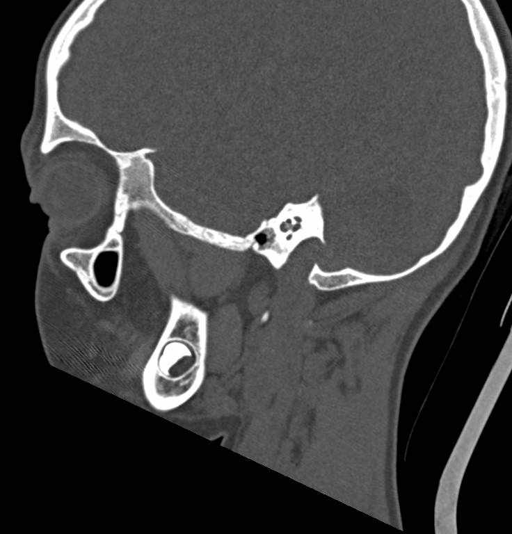 Cerebellar abscess (Radiopaedia 73727-84527 Sagittal bone window 11).jpg