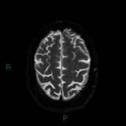 Cerebellar abscess (Radiopaedia 78135-90678 Axial DWI 54).jpg