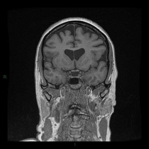 Cerebellar abscess (Radiopaedia 78135-90678 Coronal T1 C+ 63).jpg