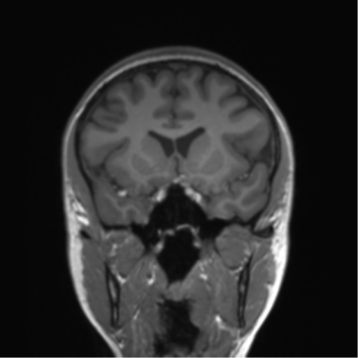 Cerebellar agenesis with hypoplastic pons (pontocerebellar hypoplasia) (Radiopaedia 57224-64138 Coronal T1 60).png