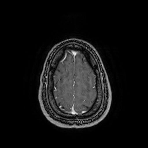 Cerebellar hemangioblastoma (Radiopaedia 88055-104622 Axial T1 C+ 152).jpg