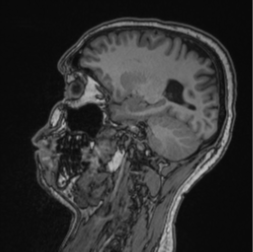 Cerebellar hemangioblastomas and pituitary adenoma (Radiopaedia 85490-101176 Sagittal T1 42).png