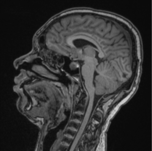 Cerebellar hemangioblastomas and pituitary adenoma (Radiopaedia 85490-101176 Sagittal T1 51).png