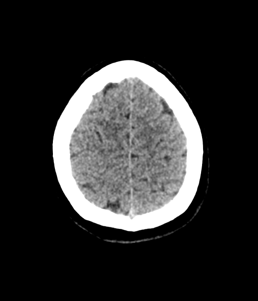 Cerebellar metastases - colorectal adenocarcinoma (Radiopaedia 40947-43652 Axial non-contrast 57).png