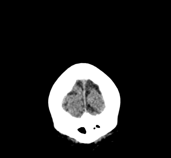 Cerebellar metastases - colorectal adenocarcinoma (Radiopaedia 40947-43652 Coronal non-contrast 12).png