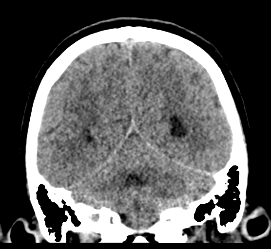 Cerebellar metastases - colorectal adenocarcinoma (Radiopaedia 40947-43652 Coronal non-contrast 67).png